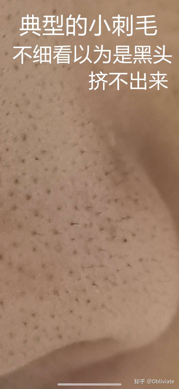 是要想老师说去黑头那样拔吗?