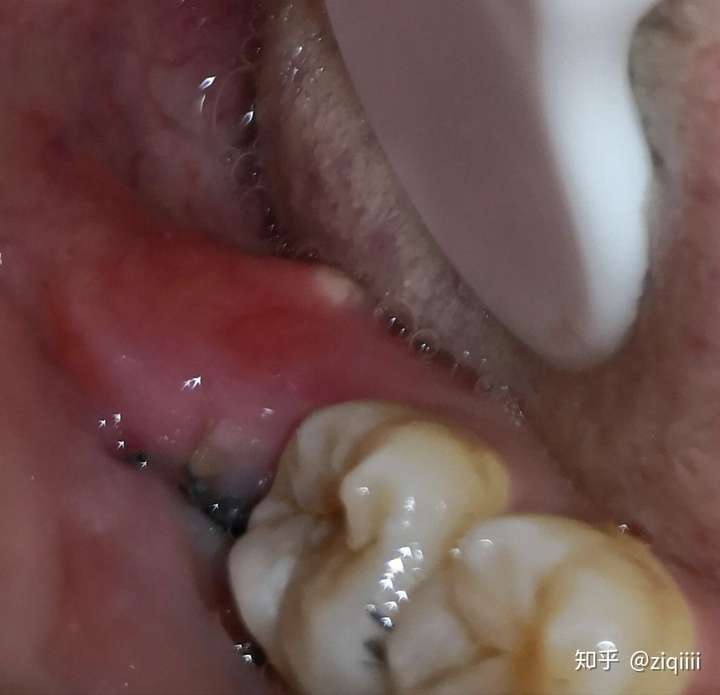 拔完智齿后舌侧牙槽骨突出顶出顶破牙龈旁边牙龈按着疼