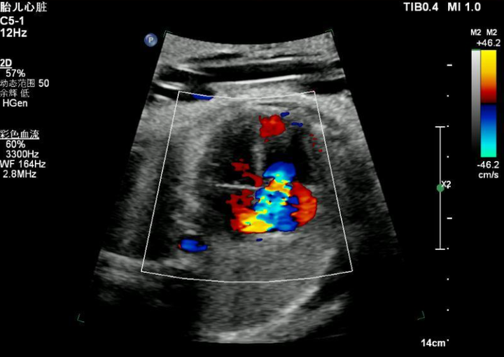 胎儿超声心动图诊断动脉导管早期收缩一例