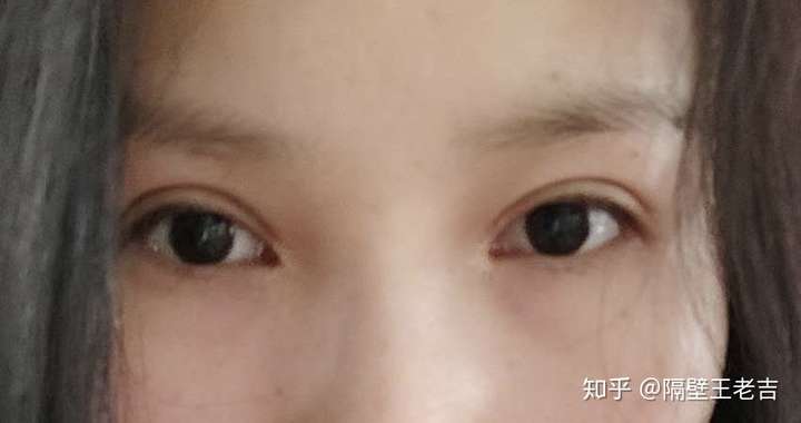 有没有在南京做双眼皮滴求医院推荐