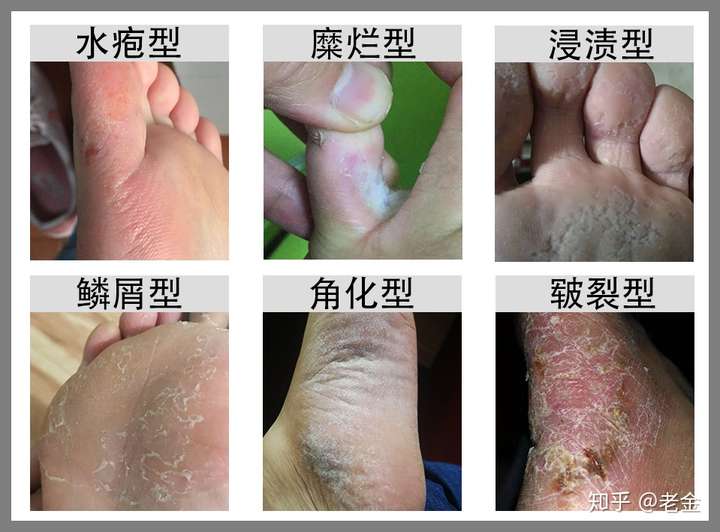 脚气是由真菌感染引起的,一般症状会有瘙痒,水泡,红肿,蜕皮,异味,角化