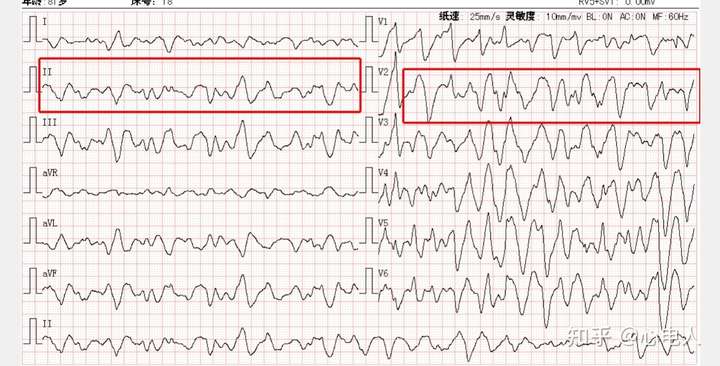 室性心律失常电风暴是指24小时内多次发多次室速室颤,患者猝死的风险