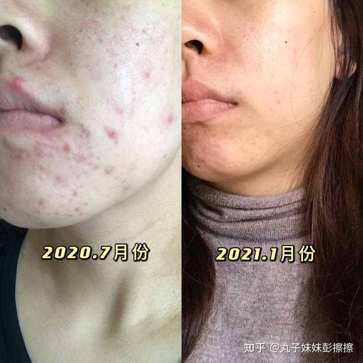 脸上有痤疮和痘坑用什么护肤品能去掉?