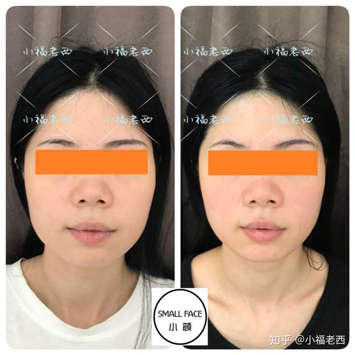 颧骨高,鼻子大,咬肌肥大,下颌宽,怎么办?哭t_t?