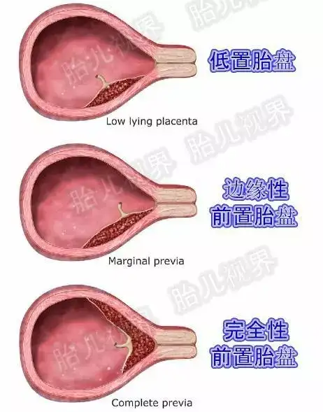 你的胎盘位置真的偏低吗