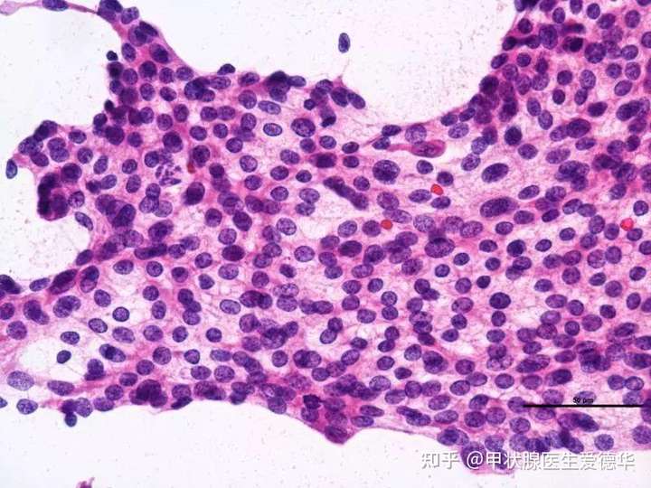 甲状腺癌一共可以分为四种: 甲状腺乳头状癌(ptc),甲状腺滤泡癌(ftc)