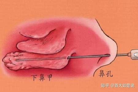 首大陈潜鼻甲肥大要如何治疗