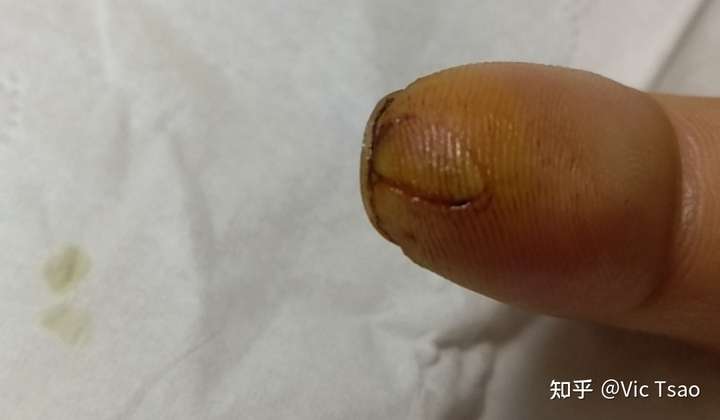 手指被切下一块肉,多长时间能恢复?