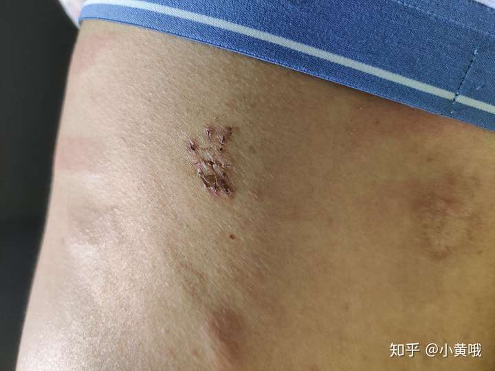 伤口结痂了