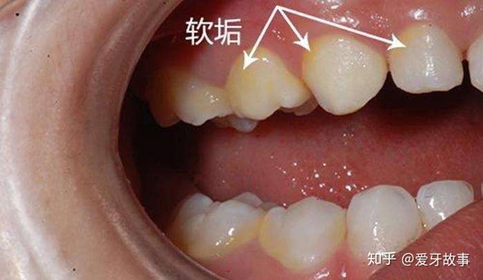 牙齿内侧根部牙龈上方黄白色的东西是什么?