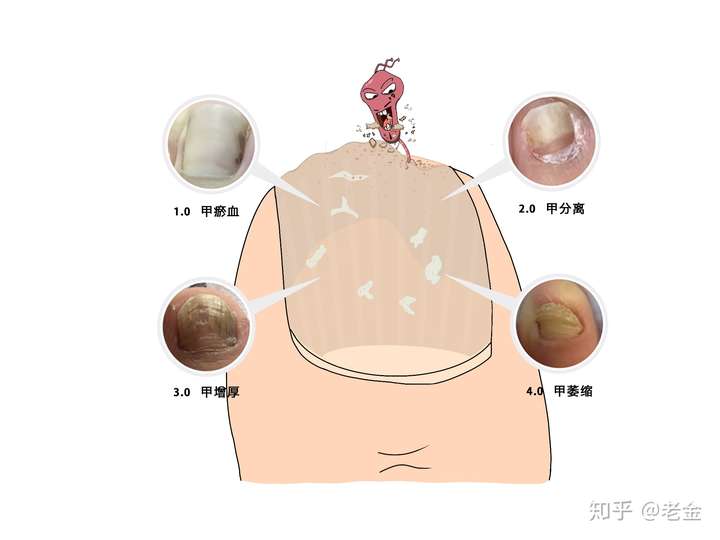 在真菌不断侵蚀下,甲菌会越来越严重,直至甲床萎缩,对指甲造成不可逆