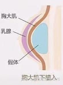 双平面隆胸是什么,和传统隆胸的区别在哪里?