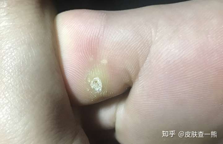 这是不是跖疣?