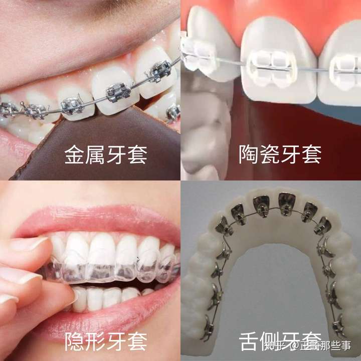 牙套种类对比图