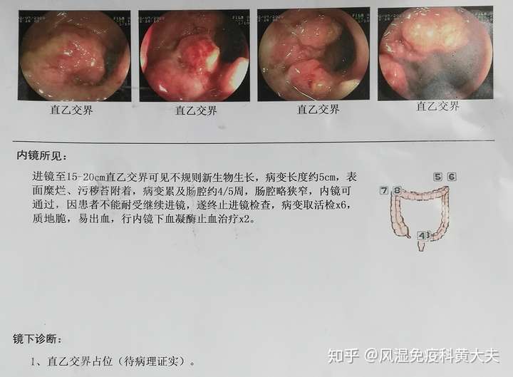 直肠癌的症状是怎样的如何预防或治疗