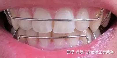 厦门牙齿矫正:关于保持器的相关知识