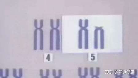 猫叫综合征的患者第5号染色体短臂缺失,故又名5p—综合征,为最常见的