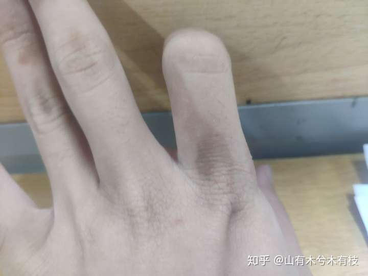 手上皮肤有几块黑的是咋回事,擦不掉,也不蜕皮?