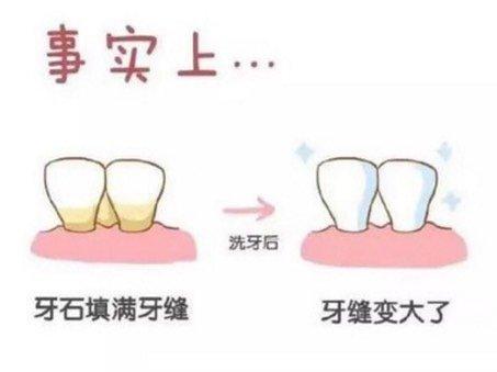 洗牙导致牙缝变大伤害牙齿吗?