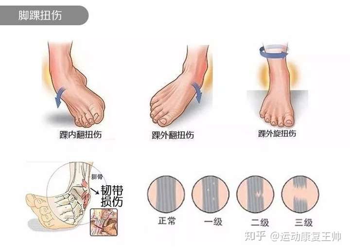 同时两个案例分析: 陈年伤的脚踝,平时都运动户外跑马,医生今日说韧带