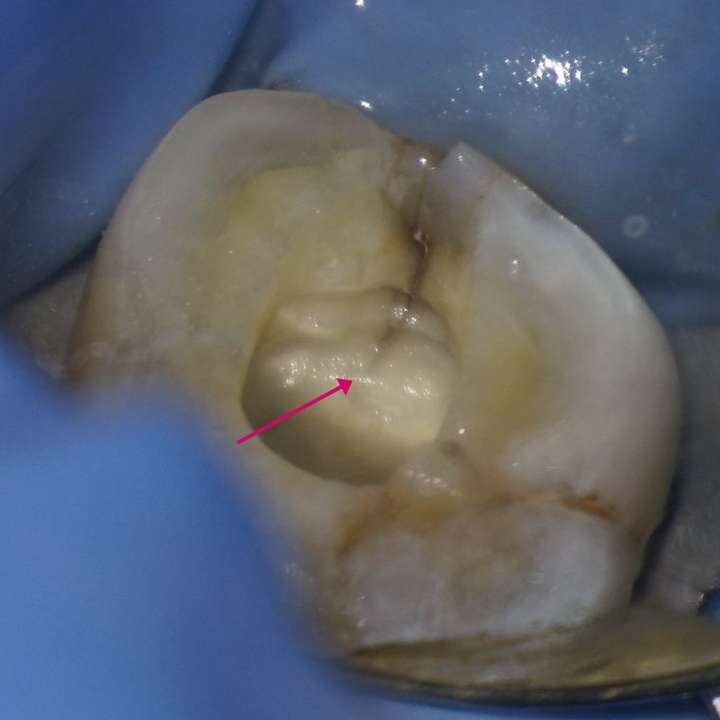 口腔显微镜下的牙齿裂纹