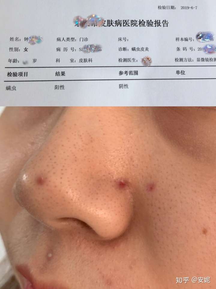 脸上有螨虫要去除吗怎么去除脸上的螨虫