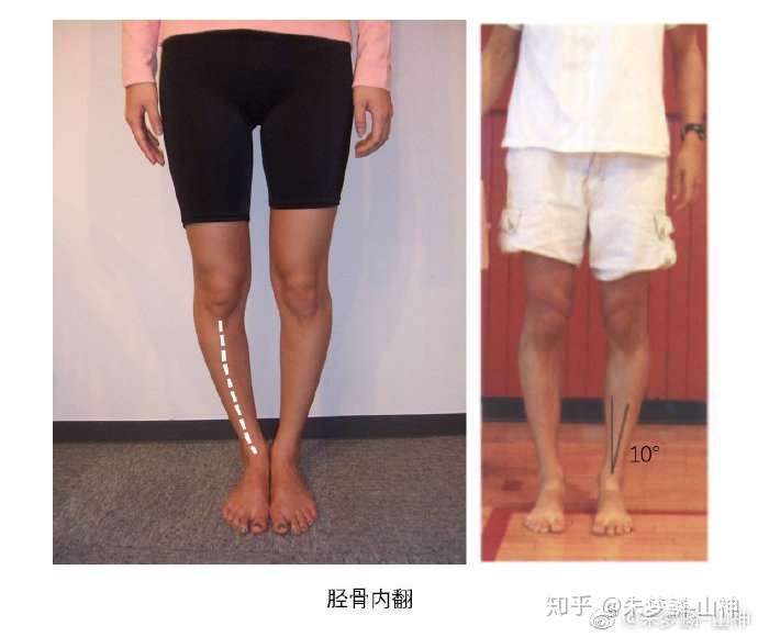 xo型腿如何靠按摩或锻炼矫正?