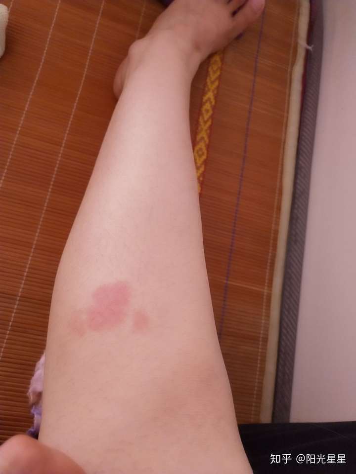 腿上接近膝盖的位置,有个粉红色像爱心一样的胎记