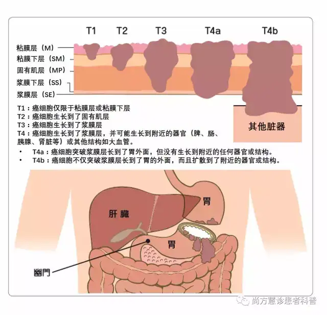 一文读懂胃癌的tnm分期