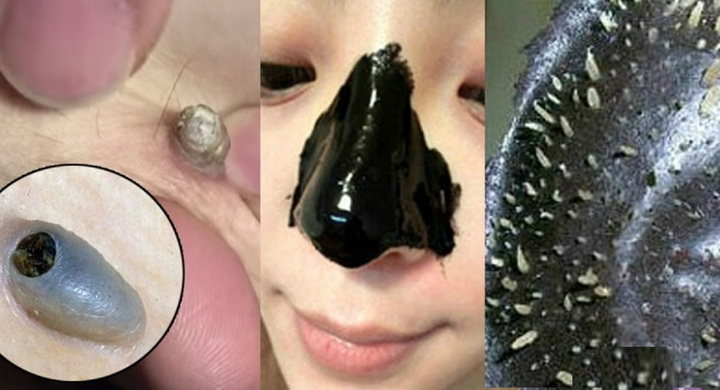 黑头又称黑头粉刺,为开放性粉刺(堵塞毛孔的皮脂的表层直接暴露在外面