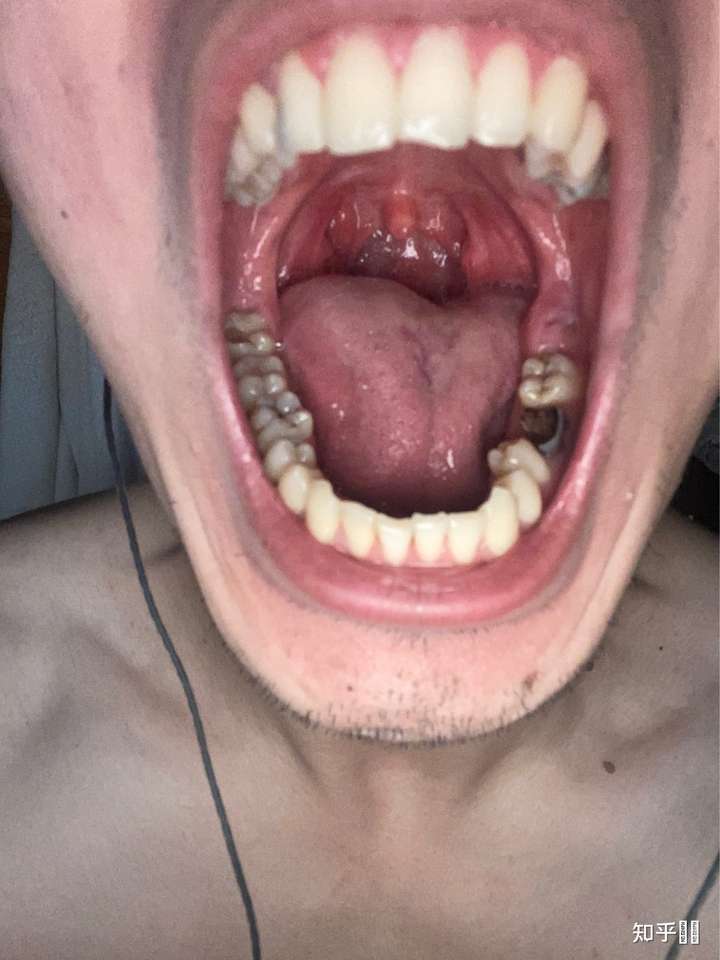 满口蛀牙是什么感觉?