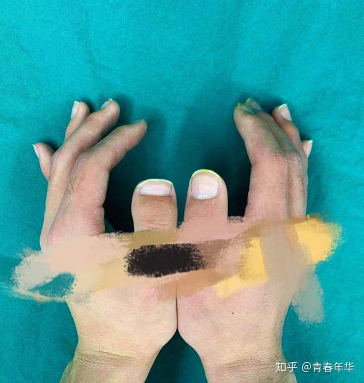 为什么我的大拇指短而宽?