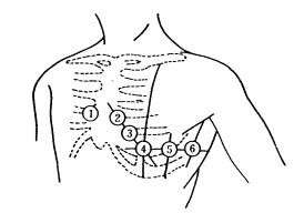 心电图12导联连接示意图