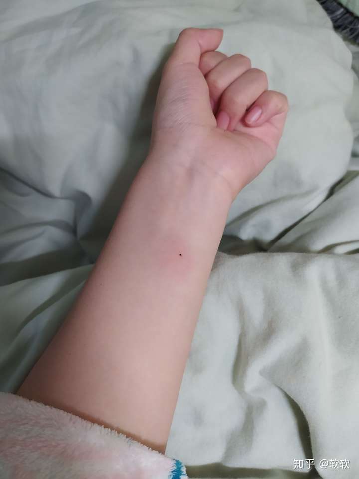 注射ppd后的正常反应图,ppd强阳性水泡图片 ppd注射后21小时