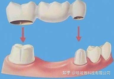 烤瓷牙为什么不建议做连冠