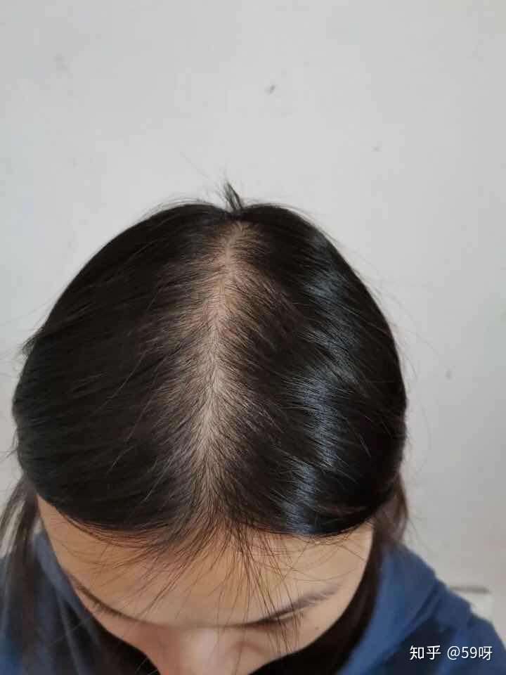 这个是我去的检查报告, 脂溢性脱发~一个毛囊只有一根(正常的3-5根)