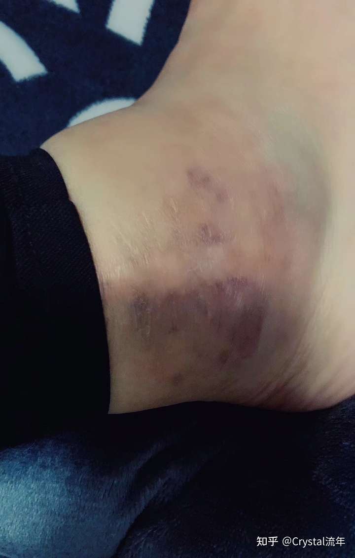 我就比较惨了,穿平底鞋都经常崴脚,穿高跟鞋甚至把脚踝崴到骨折过,但