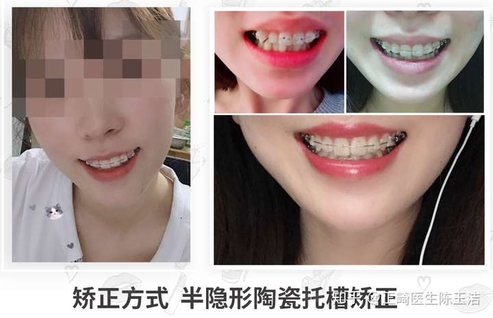 陶瓷牙套和舌侧牙套那种效果好.有什么区别.