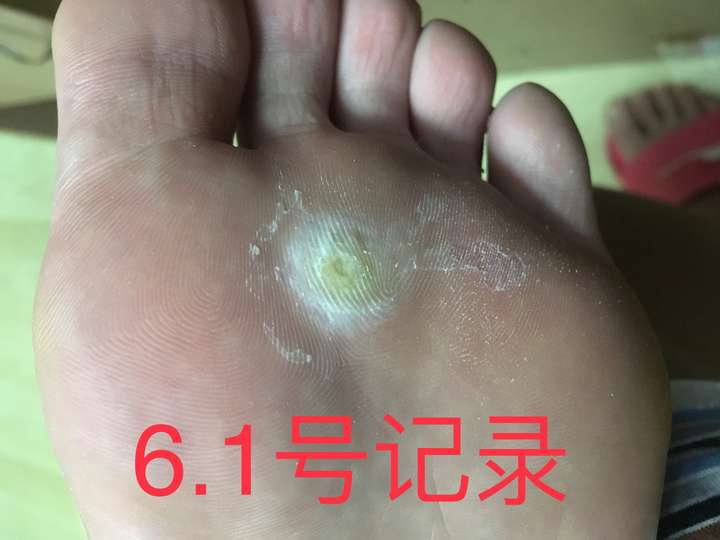 鸡眼怎么彻底挖出?