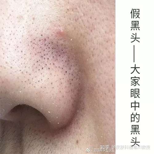 如何去鼻子上的黑头