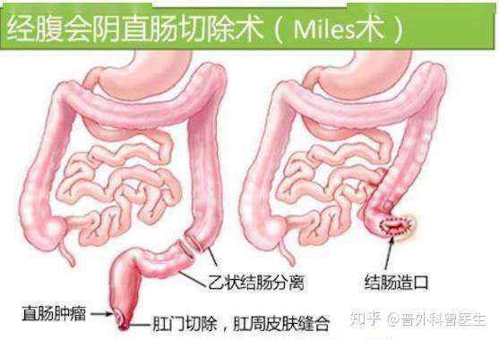 得了直肠癌医生要挖掉我的肛门以后还怎么排便宁死不做手术