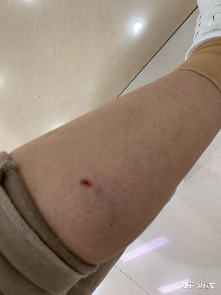 这是医院凭证和处理完的伤口,现在母乳期间,担惊受怕,还要去医院4次