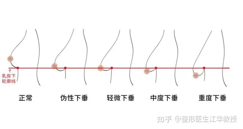 判断标准:乳头到下皱襞的距离