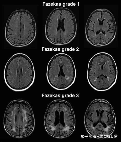 请问脑白质病变fazekas是什么意思