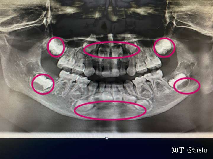 5岁的小朋友,画圈的是恒牙胚