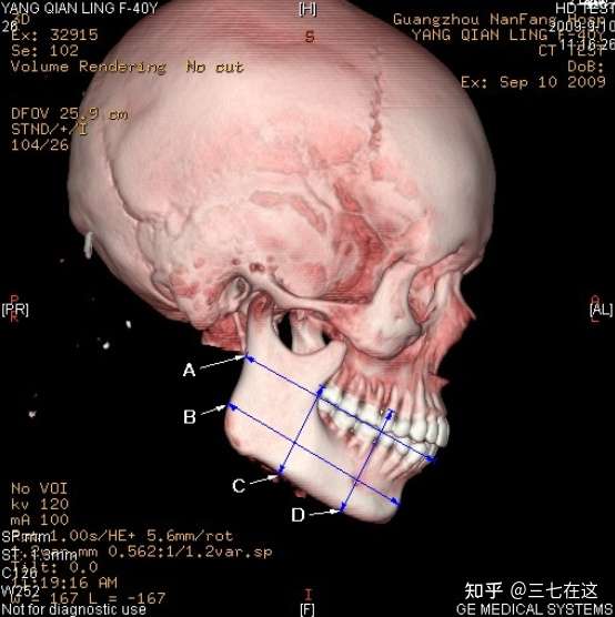 下颌骨分为三个区域 ab范围属于下颌骨后缘,bc范围属于下颌角区,cd