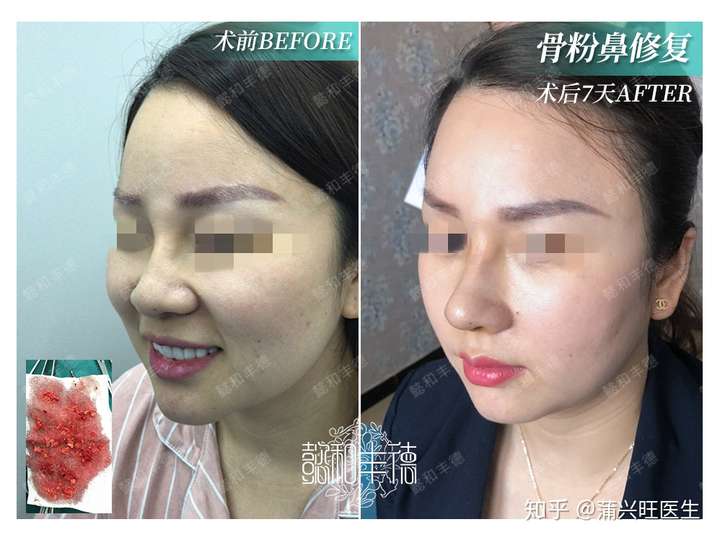 现在鼻子里的人工骨粉可以一次性清除干净吗?