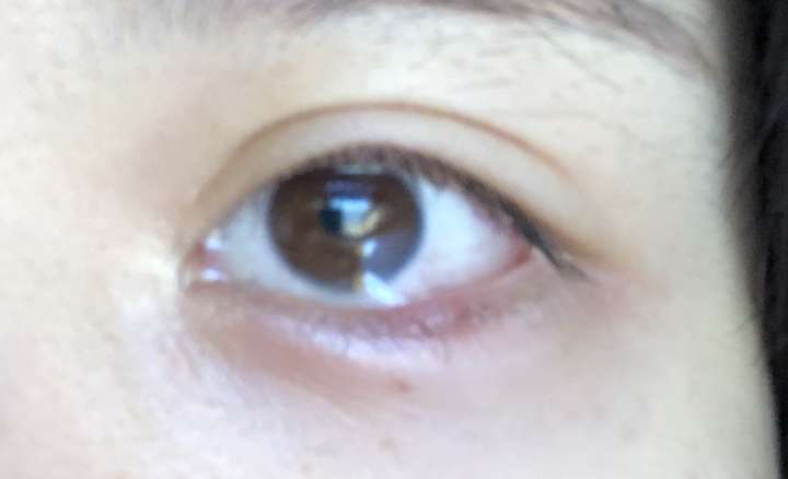 有没有得过外麦粒肿的朋友,怎么个痊愈过程.
