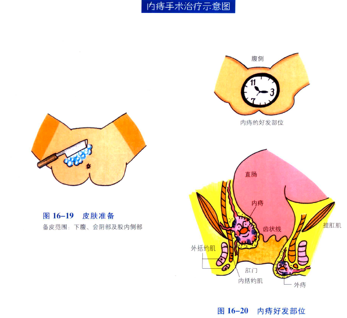 痔疮手术时要全脱掉裤子还是脱一半,痔疮痔疮手术后也是要裸着在病房