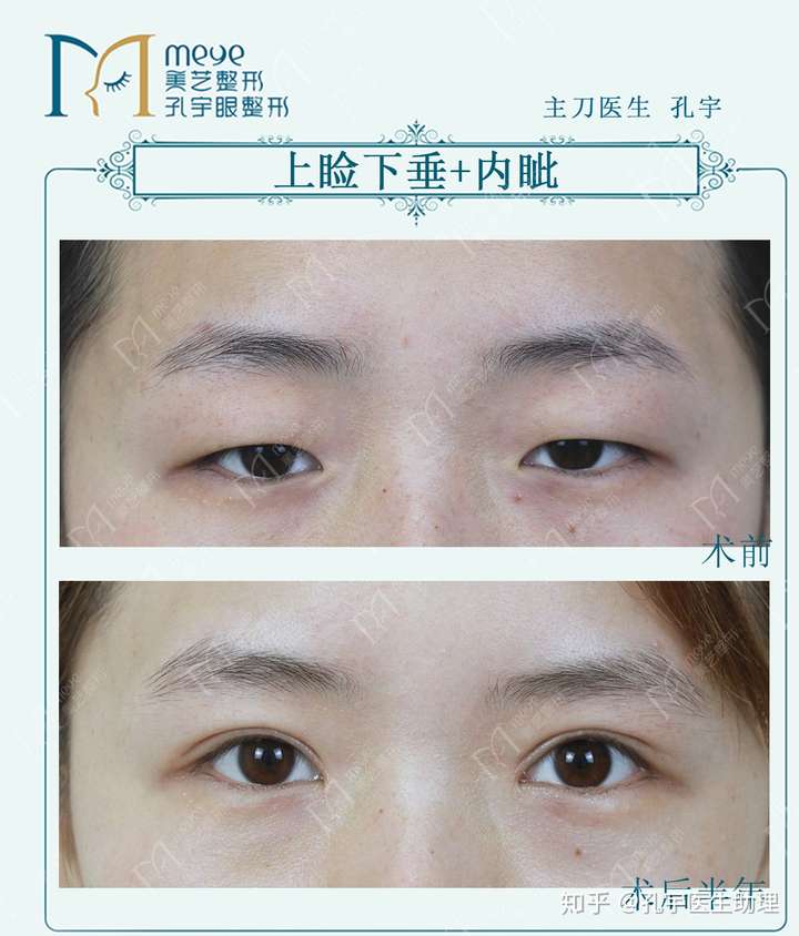 参考一下这个小姑娘的上睑下垂矫正手术效果,术后眼睛明显的有神了.